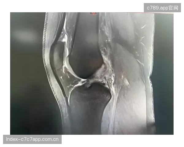 北医三院运动医学中心验证PVDF鞋垫，用于前交叉韧带重建患者的康复进程追踪